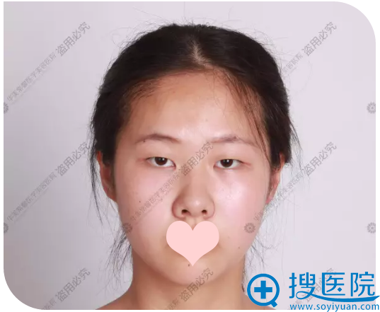 成都华美紫馨党宁医生双眼皮案例 2580元韩式双眼皮效果怎么样