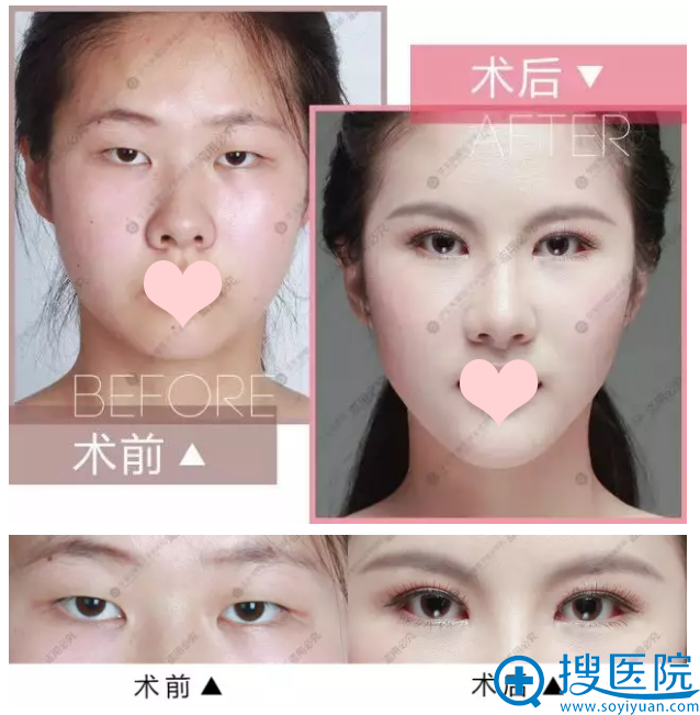 双眼皮术前术后对比照 双眼皮术前术后对比照