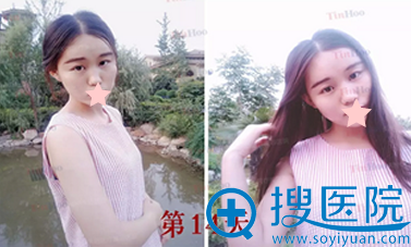 <!--<i data=20240710 data-id=12037></i>-->自体脂肪面部填充术后14天恢复图片 <!--<i data=20240710 data-id=12037></i>-->自体脂肪面部填充术后14天恢复图片