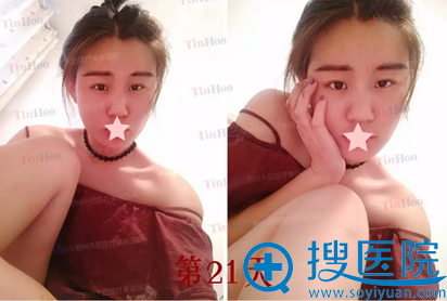<!--<i data=20240710 data-id=12037></i>--><!--<i data=20240710 data-id=17527></i>-->面部脂肪填充21天恢复图 <!--<i data=20240710 data-id=12037></i>--><!--<i data=20240710 data-id=17527></i>-->面部脂肪填充21天恢复图