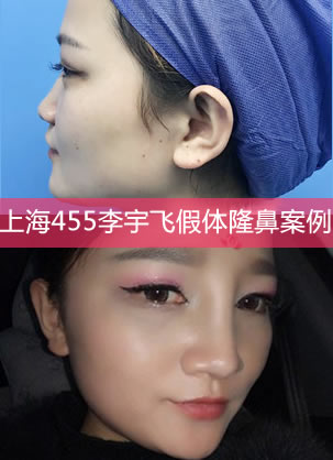 上海455医院整形医生李宇飞做硅胶假体隆鼻效果怎么样?