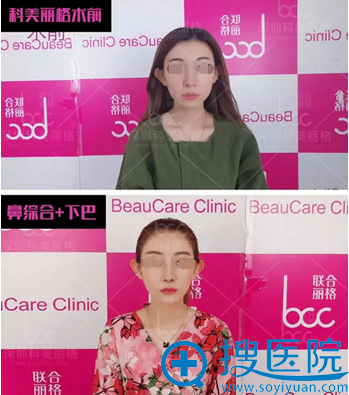 浅谈我在深圳科美丽格找徐斌做鼻综合+假体隆下巴后的整形体验