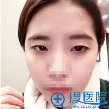 汕头名流割双眼皮好不好?多少钱?案例效果+8月整形优惠大曝光