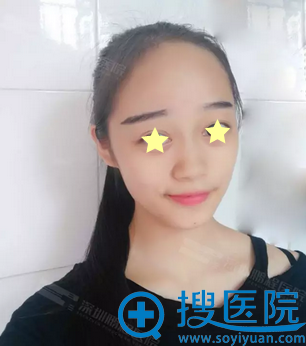 深圳鹏程医院前台MM线雕鼻+艾莉薇玻尿酸丰下巴手术日记