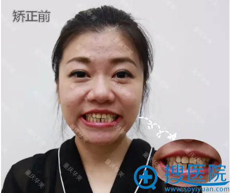 重庆华美时代天使隐形矫正案例 暑期优惠隐形牙齿矫正7599元