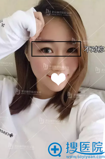 术前埋线失败,左右眼睛不对称 术前埋线失败,左右眼睛不对称