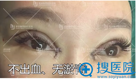 <!--<i data=20240710 data-id=16007></i>-->医生双眼皮修复天细节图 <!--<i data=20240710 data-id=16007></i>-->医生双眼皮修复天细节图
