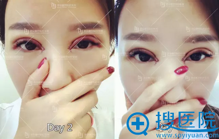 <!--<i data=20240710 data-id=16007></i>-->双眼皮修复第二天效果图 <!--<i data=20240710 data-id=16007></i>-->双眼皮修复第二天效果图