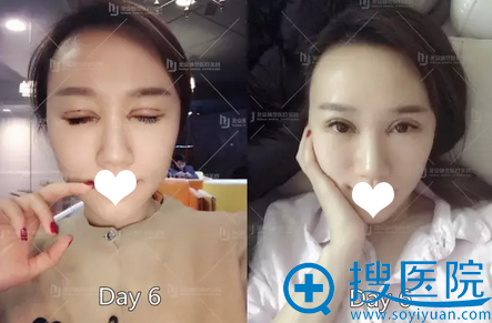 <!--<i data=20240710 data-id=16007></i>-->双眼皮修复第6天生活照 <!--<i data=20240710 data-id=16007></i>-->双眼皮修复第6天生活照
