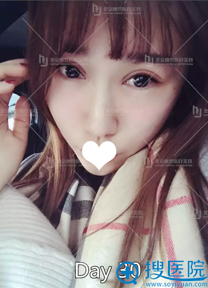 找北京<!--<i data=20240710 data-id=16007></i>-->做双眼皮修复一个月了 找北京<!--<i data=20240710 data-id=16007></i>-->做双眼皮修复一个月了