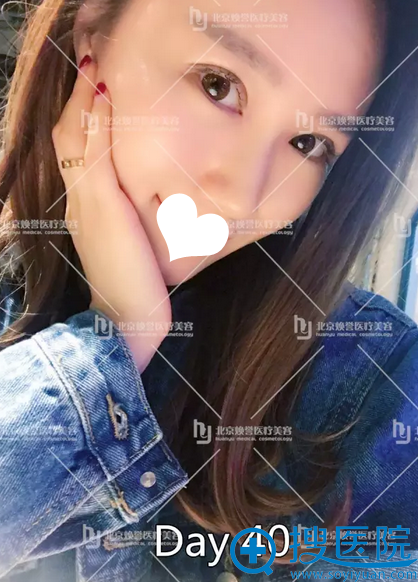 <!--<i data=20240710 data-id=16007></i>-->双眼皮修复术后40天 <!--<i data=20240710 data-id=16007></i>-->双眼皮修复术后40天