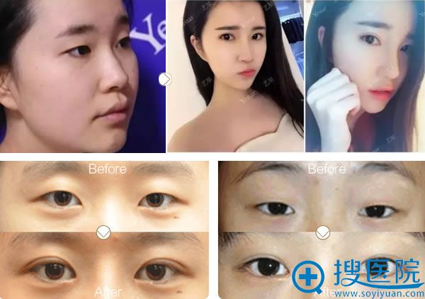 北京艺星双眼皮开眼角真实案例 北京艺星双眼皮开眼角真实案例