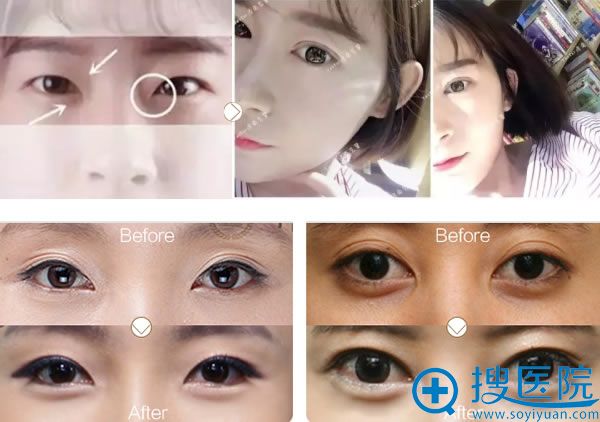 北京艺星全切双眼皮和祛眼袋案例 北京艺星全切双眼皮和祛眼袋案例