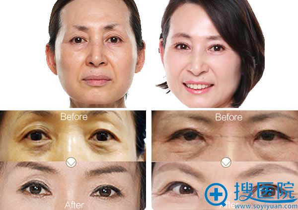 北京艺星整形眼部抗衰真实案例 北京艺星整形眼部抗衰真实案例