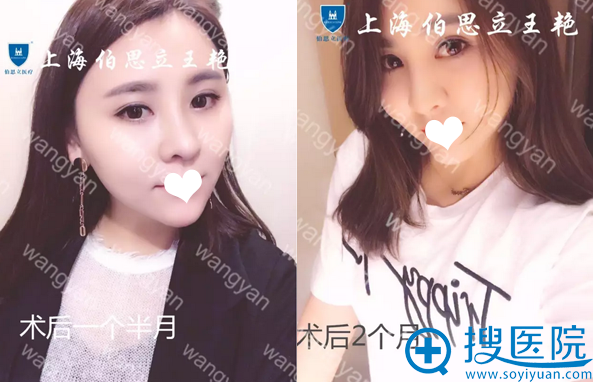 <!--<i data=20240710 data-id=14211></i>--><!--<i data=20240710 data-id=16690></i>-->隆鼻术后两个月生活照 <!--<i data=20240710 data-id=14211></i>--><!--<i data=20240710 data-id=16690></i>-->隆鼻术后两个月生活照