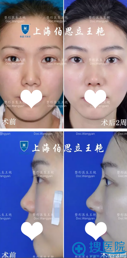 <!--<i data=20240710 data-id=16690></i>-->隆鼻术后两周前后对比图 <!--<i data=20240710 data-id=16690></i>-->隆鼻术后两周前后对比图