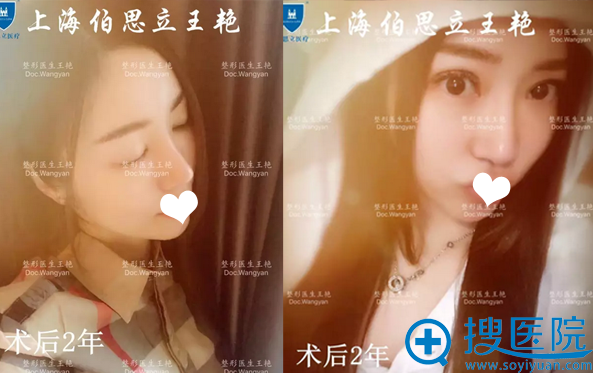 <!--<i data=20240710 data-id=14211></i>--><!--<i data=20240710 data-id=16690></i>-->隆鼻术后2年生活照 <!--<i data=20240710 data-id=14211></i>--><!--<i data=20240710 data-id=16690></i>-->隆鼻术后2年生活照