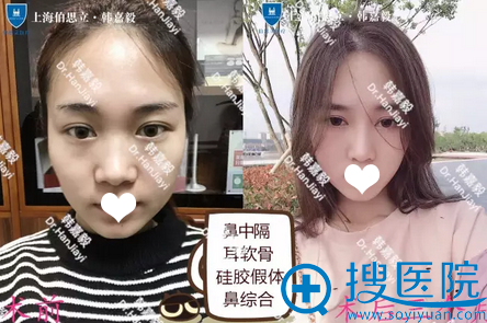 <!--<i data=20240710 data-id=14211></i>-->韩嘉毅隆鼻案例前后对比照 <!--<i data=20240710 data-id=14211></i>-->韩嘉毅隆鼻案例前后对比照