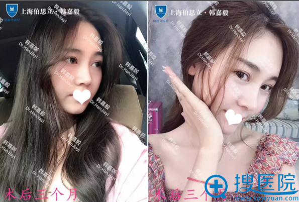 韩嘉毅做鼻子三个月效果 韩嘉毅做鼻子三个月效果
