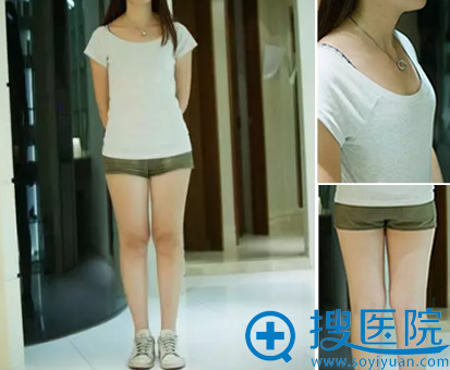 郑州自体脂肪丰胸医院——丽人医院真人案例赏析