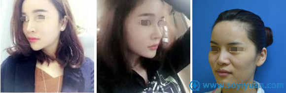 <!--<i data=20240710 data-id=8229></i>-->黄双闻面部脂肪填充3个月对比效果 <!--<i data=20240710 data-id=8229></i>-->黄双闻面部脂肪填充3个月对比效果