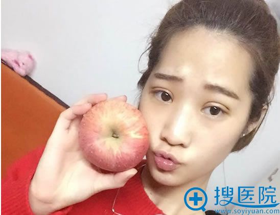 聂云飞医生双眼皮术后第3天照片 聂云飞医生双眼皮术后第3天照片