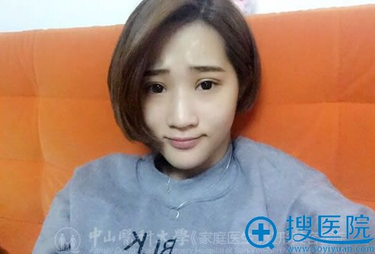 聂云飞双眼皮术后10天恢复效果 聂云飞双眼皮术后10天恢复效果