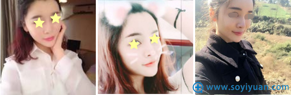 黄双闻面部脂肪填充术后一个月效果 黄双闻面部脂肪填充术后一个月效果