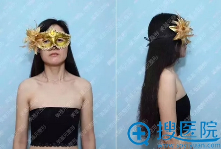 40岁的她分享找武汉美基元汪福强做假体隆胸8个月的亲身经历