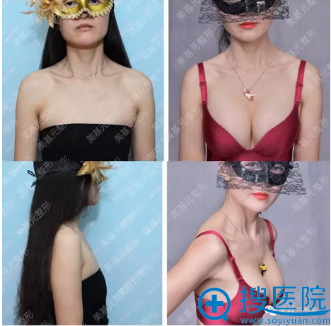 假体隆胸前后对比照 假体隆胸前后对比照