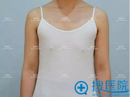 产后胸部萎缩怎么办 石家庄雅芳亚丁庆丰产后隆胸案例从A升到C