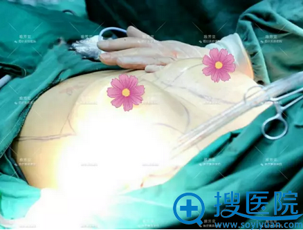 单侧假体植入后效果 单侧假体植入后效果