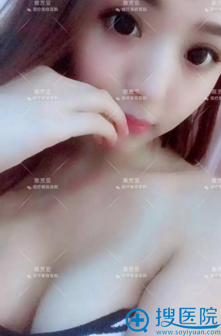 假体隆胸术后一个半月生活照 假体隆胸术后一个半月生活照