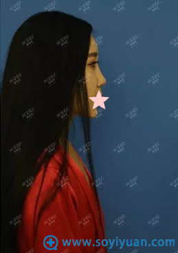 唐山美联臣假体隆胸案例:从一马平川到凹凸有致“乳”此简单