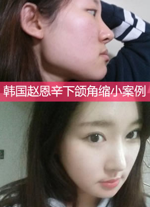 下颌角突出该怎么办 韩国赵恩辛整形辛钟寅下颌角缩小案例