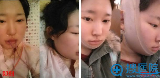 下颌角缩小手术第1天照片 下颌角缩小手术第1天照片