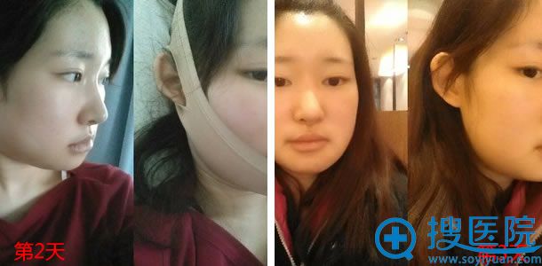 下颌角突出整形手术第2天照片 下颌角突出整形手术第2天照片