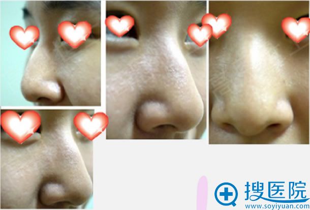 燕燕做鹰勾鼻矫正手术前照片 燕燕做鹰勾鼻矫正手术前照片
