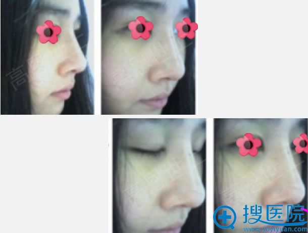 鹰钩鼻矫正手术2周的恢复过程图 鹰钩鼻矫正手术2周的恢复过程图