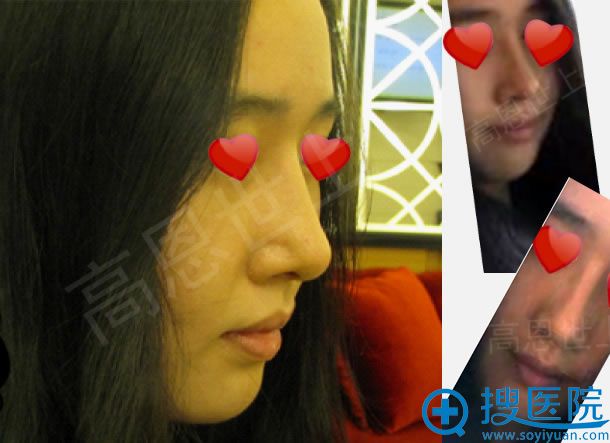 高恩世上韩国李炳烩做鼻子效果 高恩世上韩国李炳烩做鼻子效果
