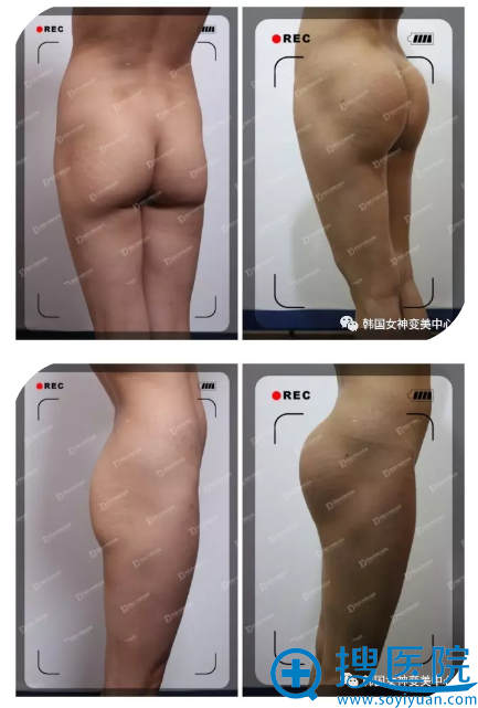 韩国女神整形医院案例 看臀部整形90天前后丰臀对比效果怎么样