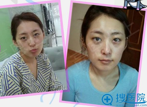 找韩国高恩世上李炳浍做鼻子前 找韩国高恩世上李炳浍做鼻子前