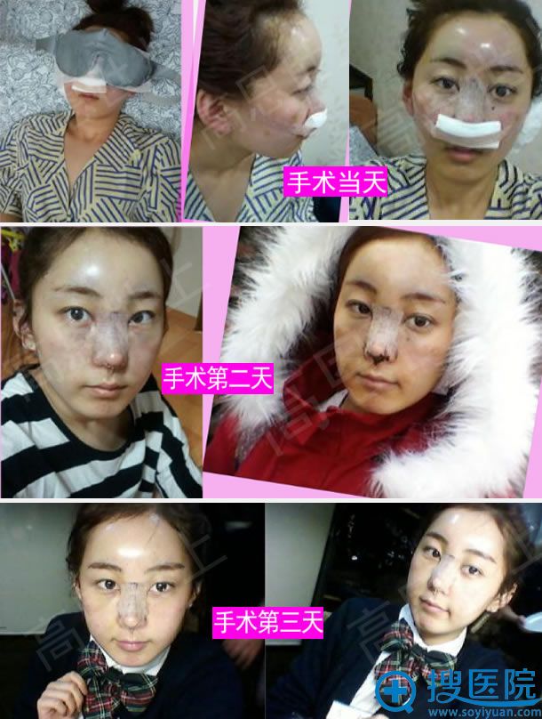 韩国做鼻子和脂肪填充手术过程图 韩国做鼻子和脂肪填充手术过程图