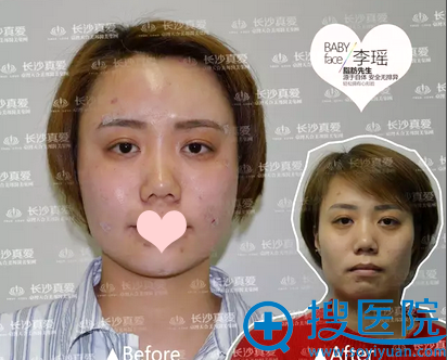 自体脂肪填充前后对比图 自体脂肪填充前后对比图