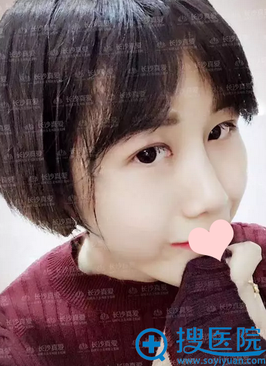 线雕隆鼻术后36天效果 线雕隆鼻术后36天效果