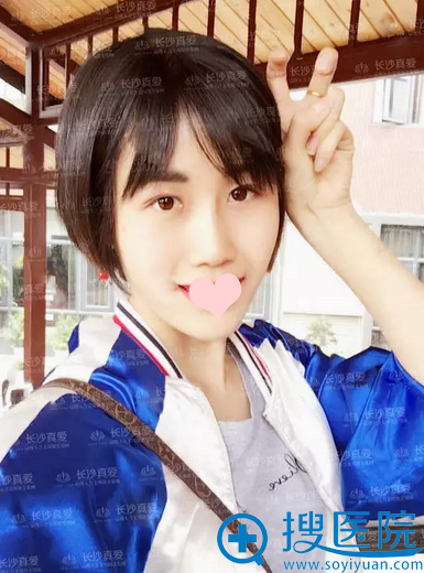 线雕隆鼻术后52天恢复效果 线雕隆鼻术后52天恢复效果
