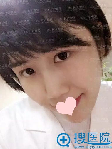 线雕隆鼻术后25天 线雕隆鼻术后25天