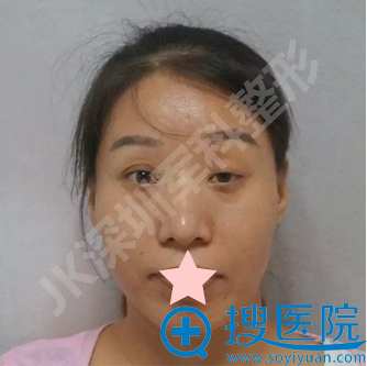深圳军科刘更月CFS上睑下垂术前照片 深圳军科刘更月CFS上睑下垂术前照片