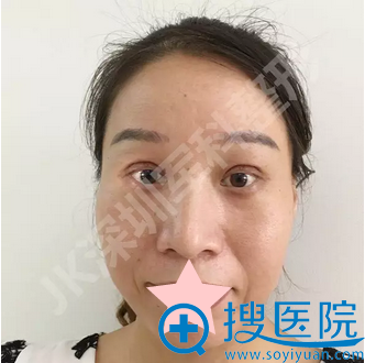 深圳军科刘更月CFS上睑下垂术后7天恢复效果 深圳军科刘更月CFS上睑下垂术后7天恢复效果
