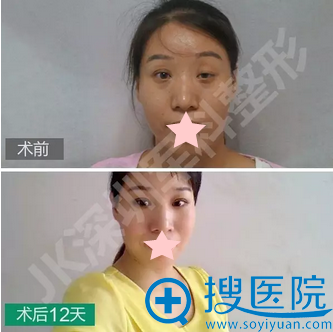 深圳军科刘更月CFS上睑下垂术后12天对比效果图 深圳军科刘更月CFS上睑下垂术后12天对比效果图